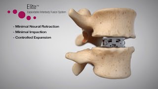 Elite™ Expandable Interbody Fusion System Animation [upl. by Akimot]