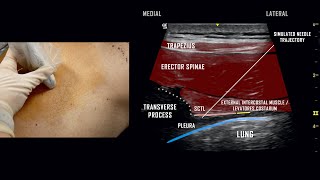 Paravertebral Block  UltrasoundGuided Demonstration [upl. by Gove]