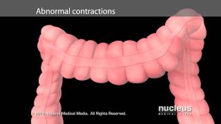 Irritable Bowel Syndrome IBS [upl. by Nogras218]