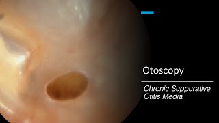 Chronic Suppurative Otitis Media Otoscopy [upl. by Burns]