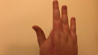 Questions About My Amputated Finger [upl. by Adnahcir29]