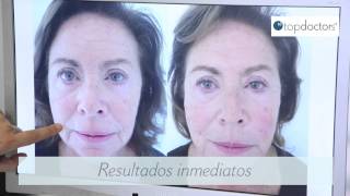 Hilos tensores para el tratamiento facial [upl. by Eelegna141]