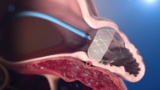 WATCHMAN Implantation Technique [upl. by Retseh]