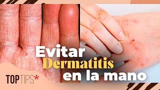 Hongos En Las Manos Cómo Evitar La Dermatitis  Top Tips [upl. by Haon630]