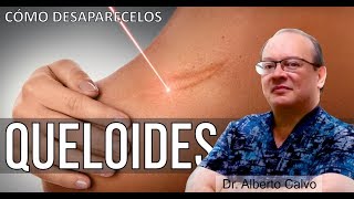 Cómo DESAPARECER las DESAGRADABLES CICATRICES QUELOIDES 🙂 Dr ALBERTO CALVO QUIROZ [upl. by Atoiyanap]