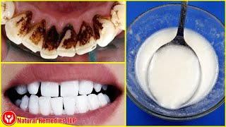 No Need For A Dentists Advice Remove Plaque And Tartar With Only These 3 Ingredients [upl. by Fair]