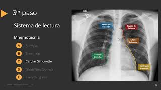 CT assessment  measuring aortic root [upl. by Aliet]