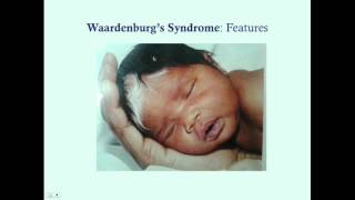 Waardenburgs Syndrome  CRASH Medical Review Series [upl. by Liam]