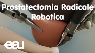 Prostatectomia Radicale Robotica [upl. by Anyaj472]