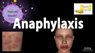 Anaphylaxis Animation [upl. by Nepsa]