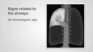 Tracheal intubation direct laryngoscopy [upl. by Weber]