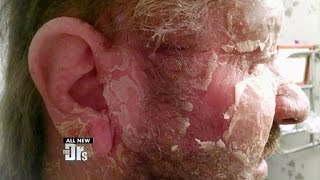 Help for Man with Extreme Eczema [upl. by Alysoun819]