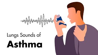 Sounds of Asthma  Wheezing Lung Sounds [upl. by Lazaro]