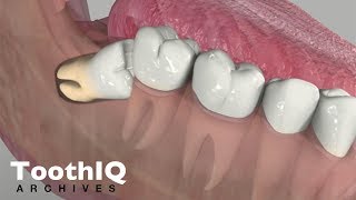 Impacted Tooth Removal [upl. by Cochard]