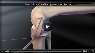 InternalBrace™ MCL Augmentation Repair [upl. by Etti980]