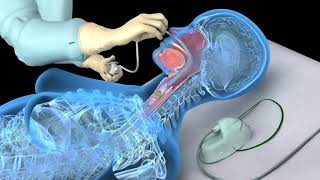 Trach Breathing and Swallowing [upl. by Grover536]