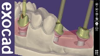 exocad Video Tutorial basic Custom Abutment Design [upl. by Hambley]