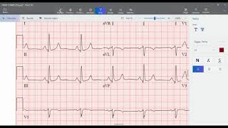 ¿Qué son las enfermedades cardiovasculares [upl. by Gonta]