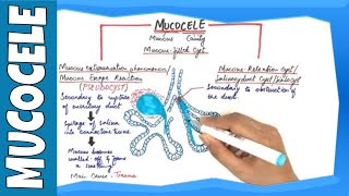 Mucocele  Types Clinical Features Histopathalogic features amp Treatment [upl. by Siro]