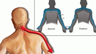 Terapia manual para cervicobraquialgia o Epicondilitis [upl. by Cormick]