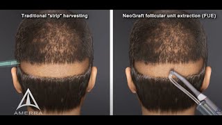 NeoGraft hair transplant procedure  animation [upl. by Louanne]