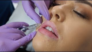 Lip Fillers  what to expect during the procedure  The Laser amp Skin Clinic [upl. by Arly28]