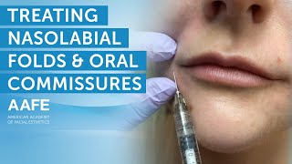 Using Dermal Fillers to Fill and Smooth Smile Lines  AAFE [upl. by Vasyuta]