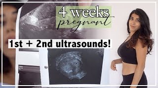 Fast Heartbeat During Pregnancy  Reasons Signs amp Treatment [upl. by Ellynn]