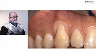 Prof Giovanni Zucchelli Treatment of class I gingival recession [upl. by Lagasse158]