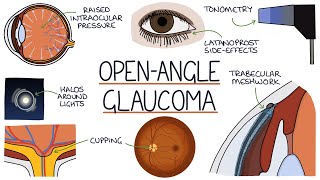 Understanding Open Angle Glaucoma [upl. by Wesle]