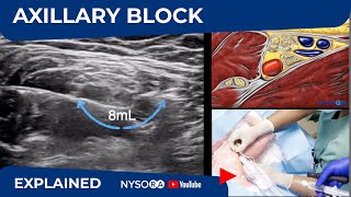 Ultrasound Guided Axillary Brachial Plexus Block NYSORA Regional Anesthesia [upl. by Zephan]