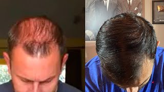 Hair Restoration Laboratories Shampoo Before and After Does It Work [upl. by Immot438]