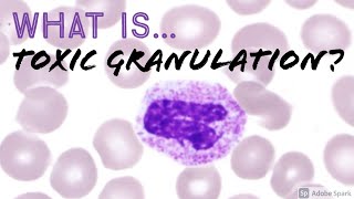 What is quotToxic Granulationquot of Neutrophils Why does it happen Hemepath Hematology Basics [upl. by Gael]