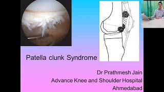 Patellar Clunk Syndrome [upl. by Halehs291]