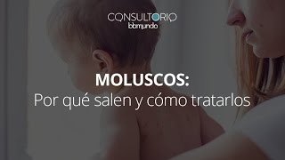 Moluscos qué los ocasiona y cómo tratarlos  Consultorio bbmundo [upl. by Gilead110]