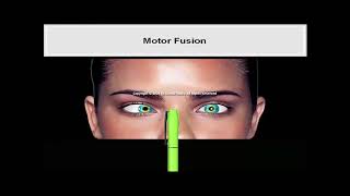 10 Symptoms in Heterophoria and Heterotropia and the Psychological Effects of Strabismus Animated [upl. by Azarria]