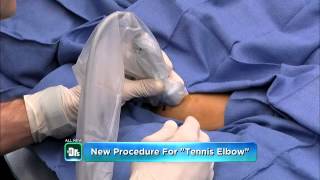 The Doctor’s Show feature New procedure to relieve tennis elbow [upl. by Aneek]