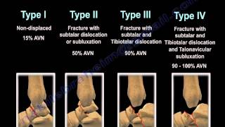 Talus Fracture Types  Everything You Need To Know  Dr Nabil Ebraheim [upl. by Volnak]