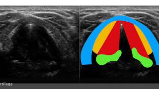 Neck Larynx Vocal cord paralysis [upl. by Eddie401]