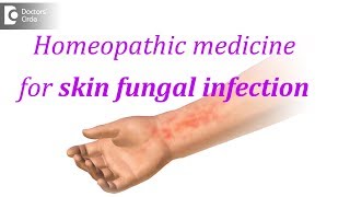 Homeopathic medicine for skin fungal infection  Dr Surekha Tiwari [upl. by Aiel461]