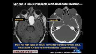 Sphenoid Sinus Mucous Retention Cyst vs Mucocele [upl. by Plunkett]