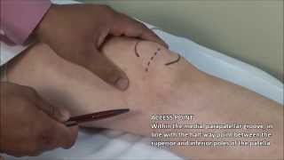 Knee Injection  Medial Approach [upl. by Hogen]