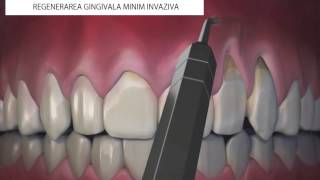 Regenerare gingivala minim invaziva [upl. by Neneek]