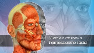 Hemiespasmo Facial Clínica Las Condes [upl. by Lotsirk]