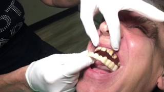 Houston Cosmetic Dentist Snapon Smile and Menchipped gaps yellow teeth [upl. by Amaryllis895]