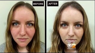 Dr Max Gomez Rosacea Treatment [upl. by Rebecca935]