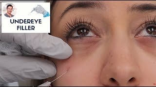 Undereye Filler By Leif Rogers MD FACS  Fanning Technique  Beverly Hills [upl. by Noived]