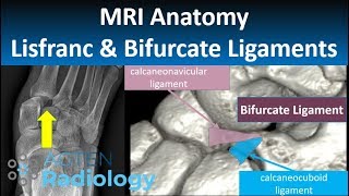 Lisfranc and Bifurcate Ligaments MRI Anatomy [upl. by Nylle]