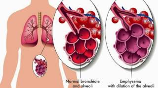 Difference Between Asthma and Bronchitis [upl. by Zavala]