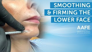 Smoothing Lower Face Fine Lines with Dermal Filler  AAFE [upl. by Avek756]